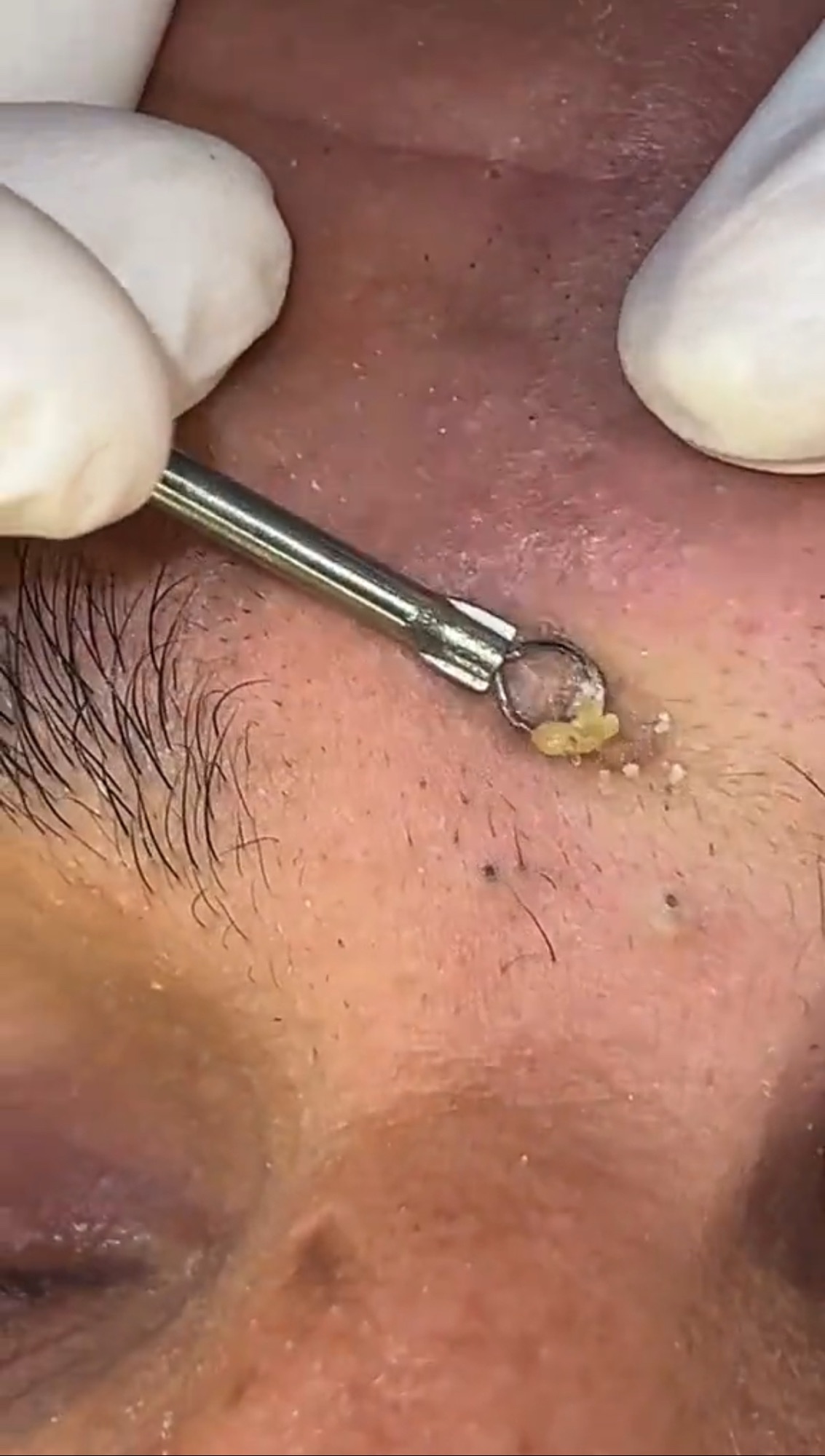 Satisfying Popping Video