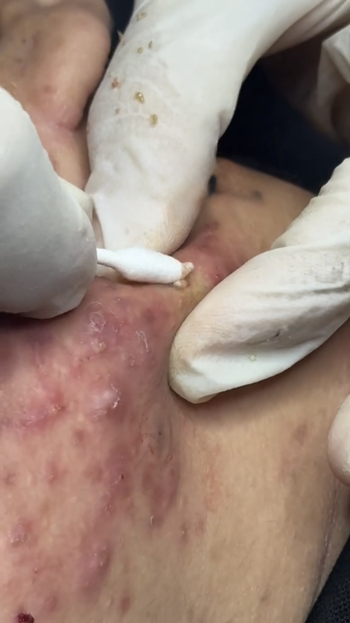 Relaxing Blackheads / Pimple / Acne Popping