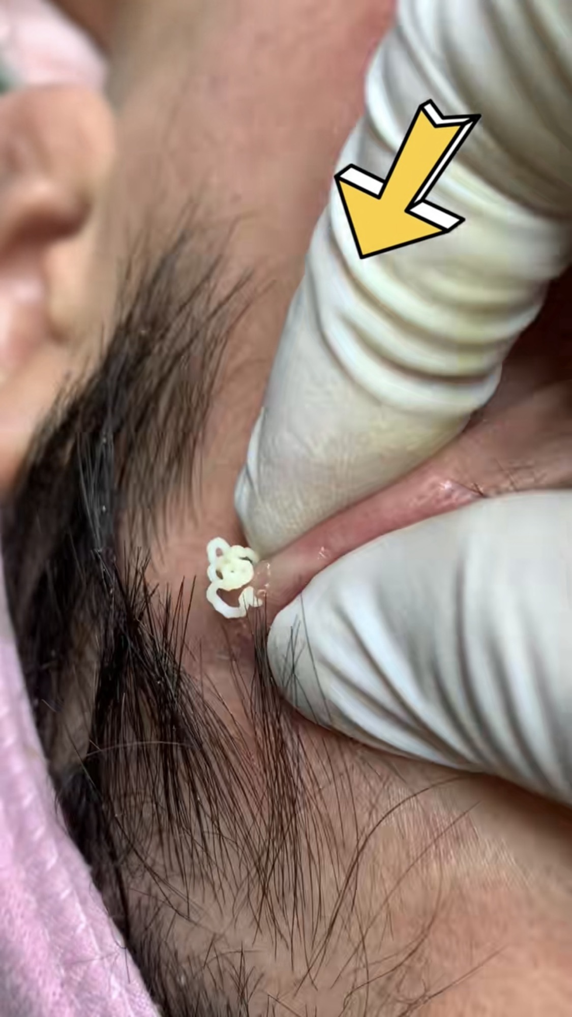 Blackheads removal on face