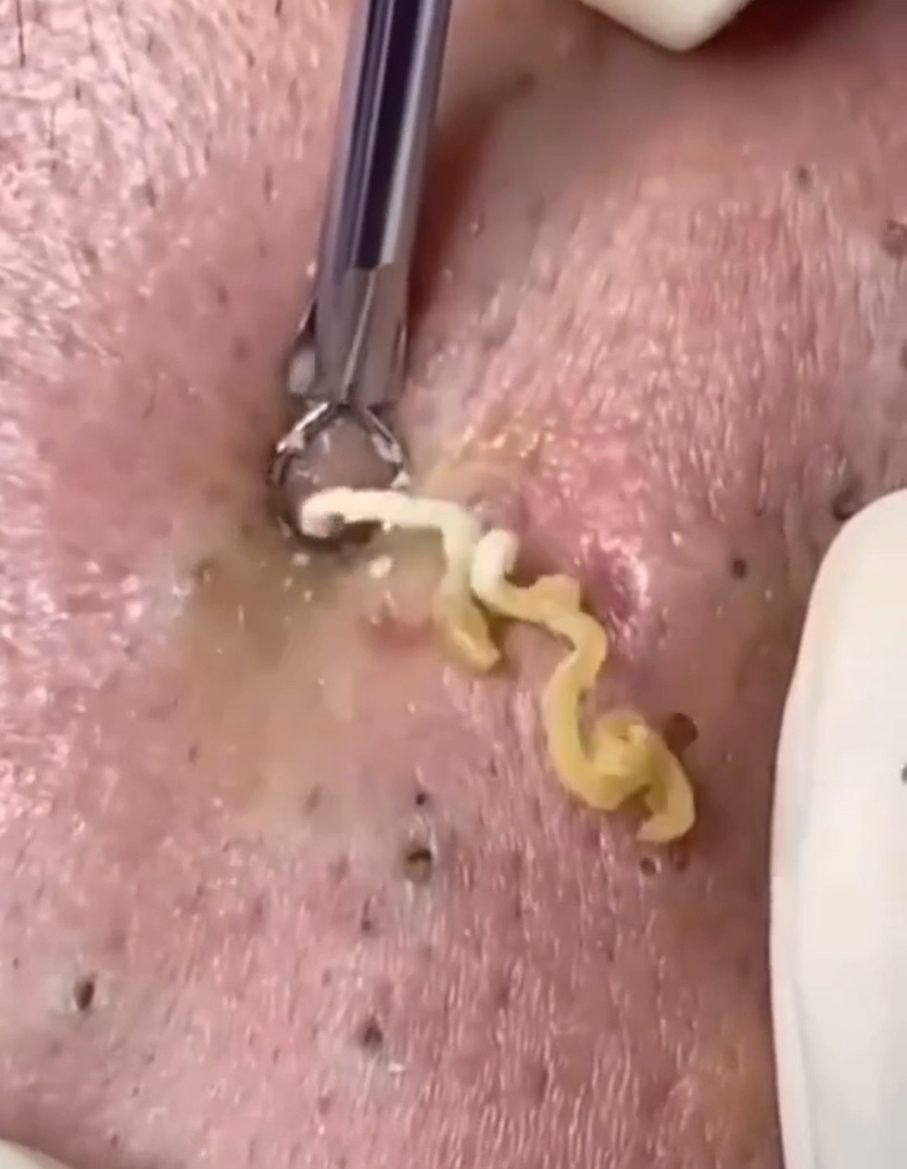 Ultra Huge Blackheads Removal on Face